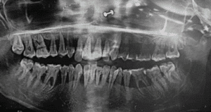 Generalised aggressive periodontitis