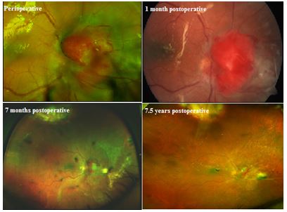 Ultra-widefield fundus images