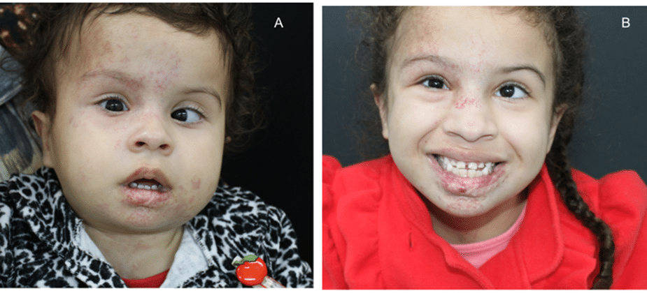 Hemangioma Of Phaces Syndrome A Case Report