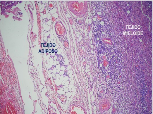 myelolipoma