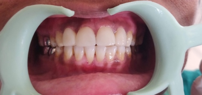 Veneer cementation