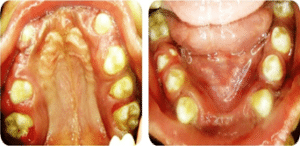 Papillon LeFevre syndrome