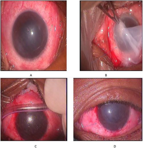 Grade 4 ocular surface burn