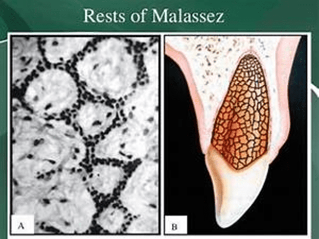 Epithelial rests of Malassez.