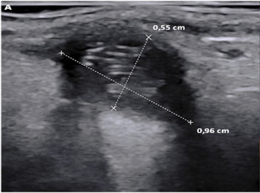 echogenic posterior