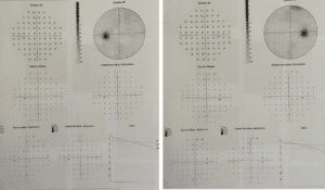 Perimeter of patient