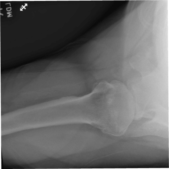 Systematic Review of Lesser Tuberosity Osteotomy Techniques, Outcomes ...