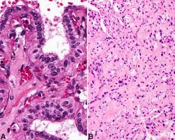 sac tumour