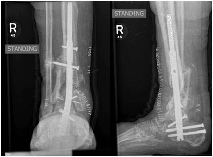 Retrograde Tibia Intramedullary Nailing Retrograde Tibia Intramedullary Nailing