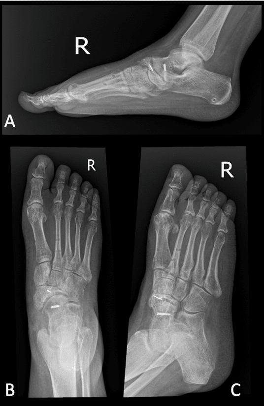 Kohler's Disease Case Report: Treatment with Regenerative Distraction ...